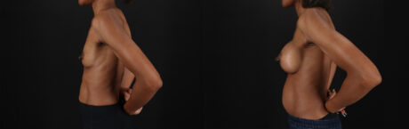 Breast Augmentation case #6485