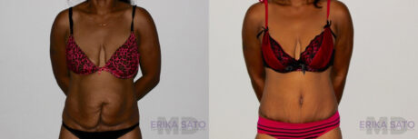Tummy Tuck case #7081
