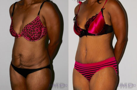 Tummy Tuck case #7081