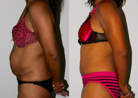 Tummy Tuck case #7081