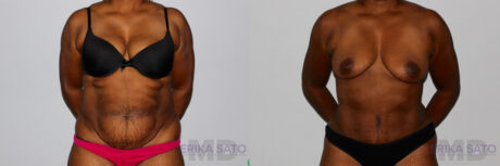 Tummy Tuck case #7089