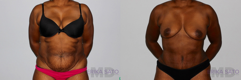 Tummy Tuck case #7089