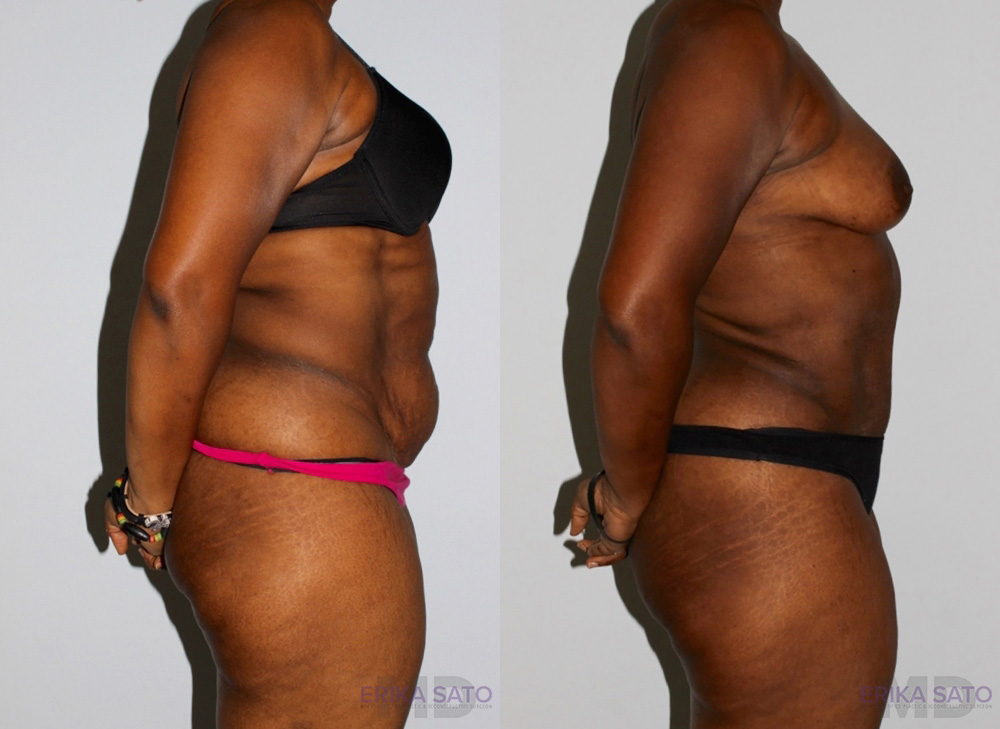 Tummy Tuck case #7089