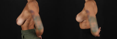 Breast Reduction case #8025