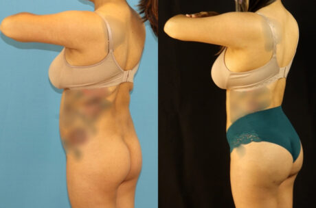 Brazilian Butt Lift case #5117