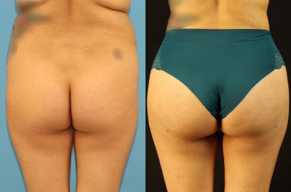 Brazilian Butt Lift case #5117