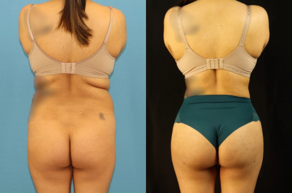 Brazilian Butt Lift case #5117