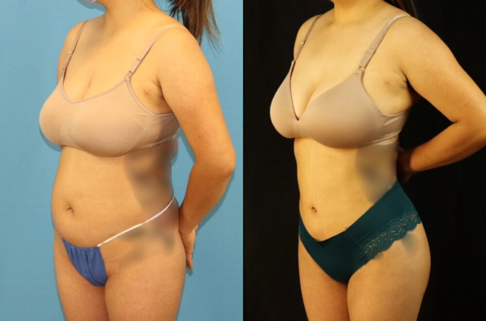 Brazilian Butt Lift case #5117