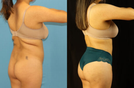 Brazilian Butt Lift case #5117