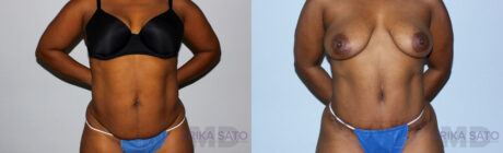 Tummy Tuck case #7080