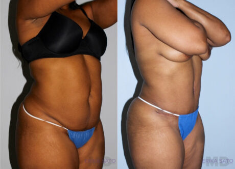 Tummy Tuck case #7080