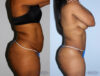 Tummy Tuck case #7080 slider thumbnail