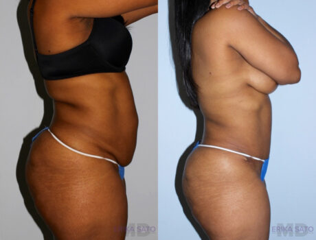 Tummy Tuck case #7080
