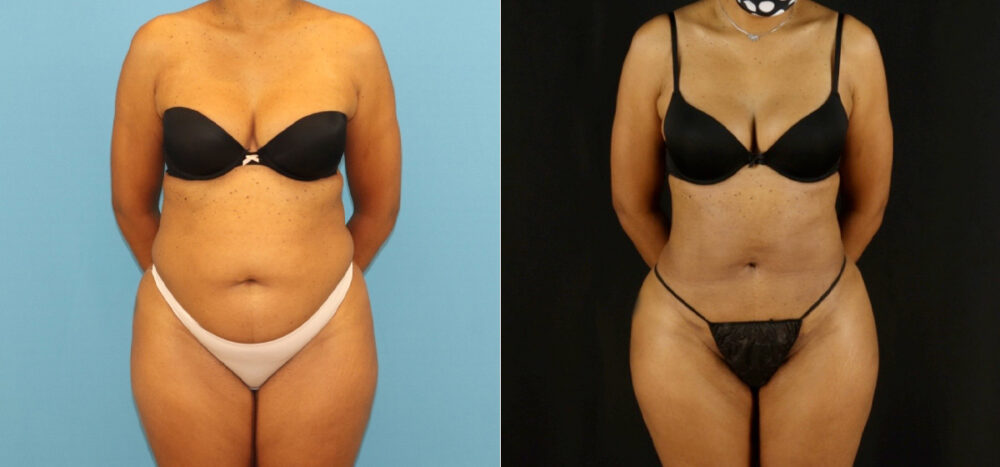 Brazilian Butt Lift case #5115