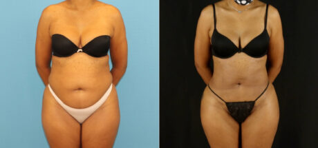 Brazilian Butt Lift case #5115