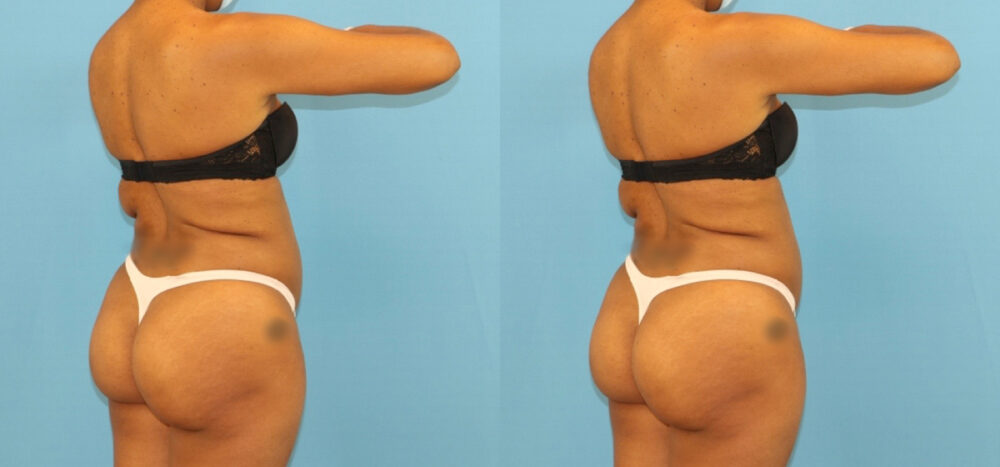 Brazilian Butt Lift case #5115