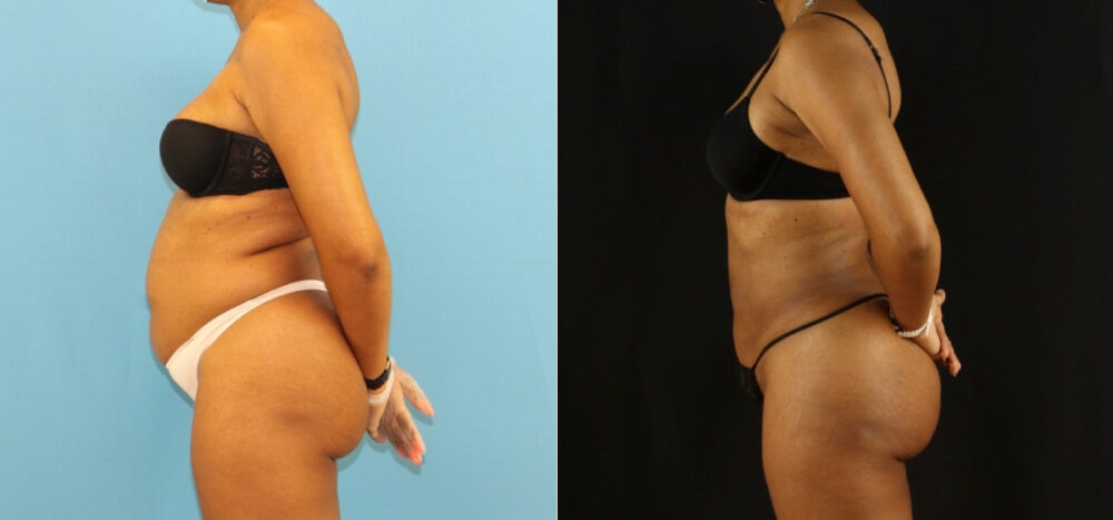 Brazilian Butt Lift case #5115