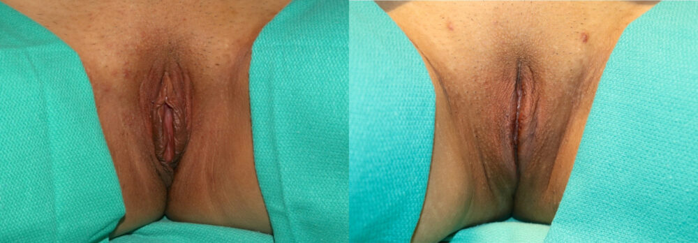 Labiaplasty case #5768
