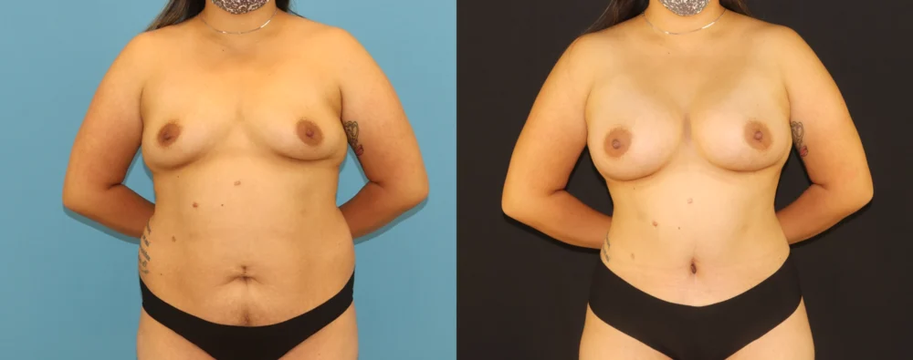 Mommy Makeover case #6513