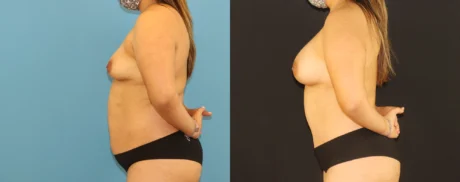 Mommy Makeover case #6513