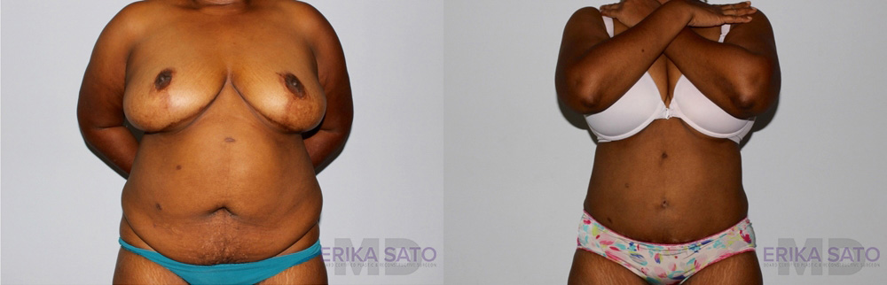 Tummy Tuck case #7090