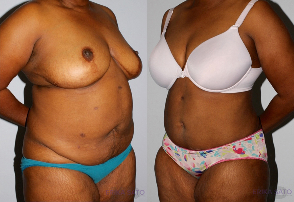 Tummy Tuck case #7090