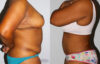 Tummy Tuck case #7090 slider thumbnail