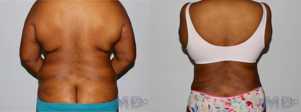 Tummy Tuck case #7090