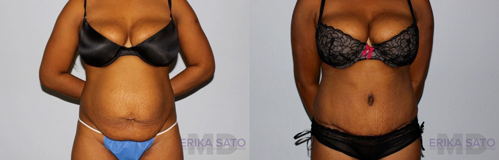 Tummy Tuck case #7079