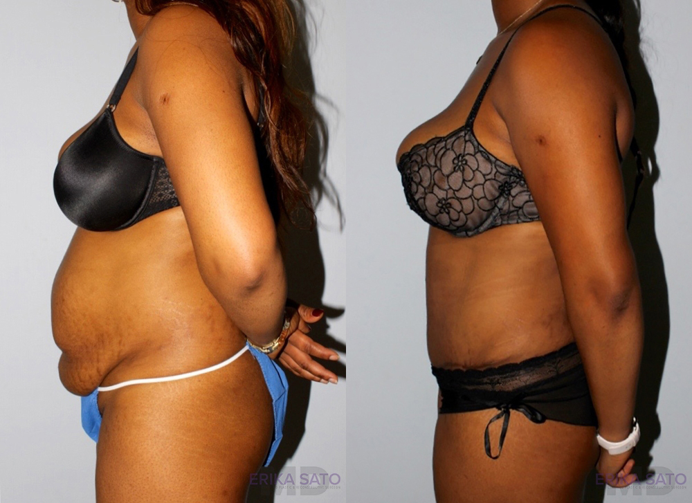 Tummy Tuck case #7079