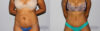 Tummy Tuck case #7092 slider thumbnail