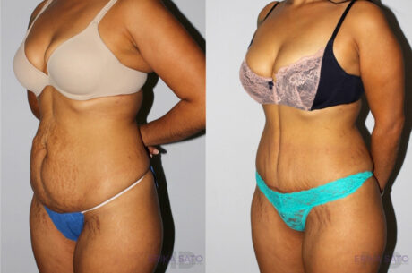 Tummy Tuck case #7092