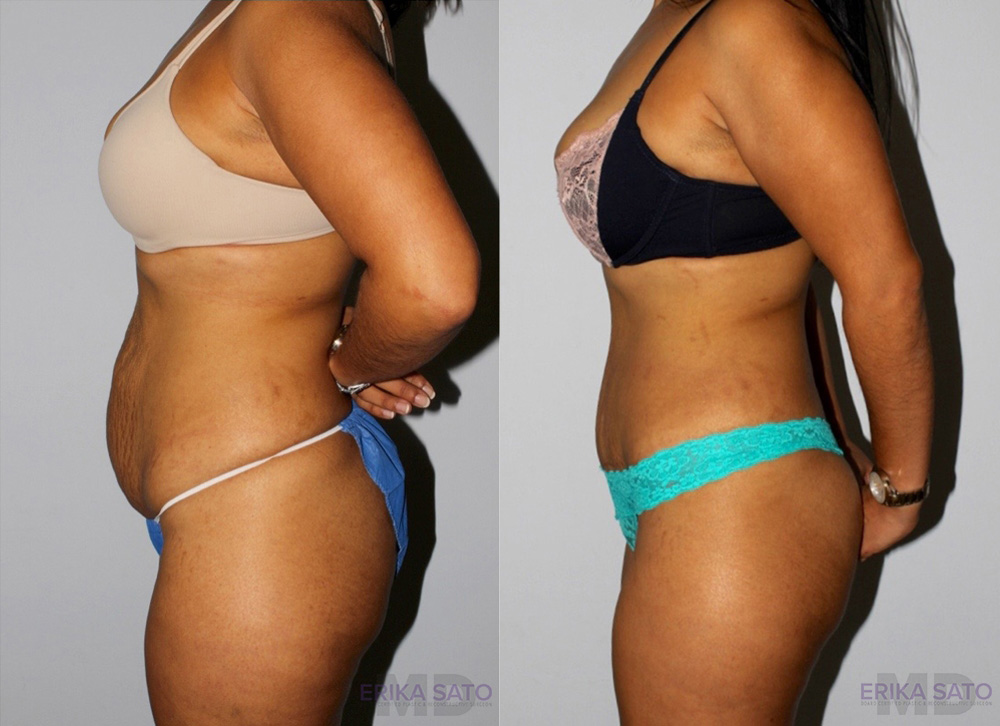 Tummy Tuck case #7092