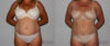 Tummy Tuck case #7091 slider thumbnail
