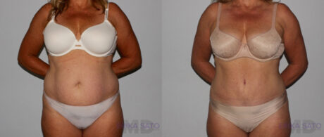 Tummy Tuck case #7091