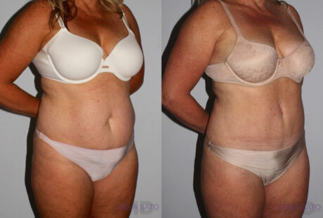 Tummy Tuck case #7091