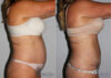 Tummy Tuck case #7091 slider thumbnail