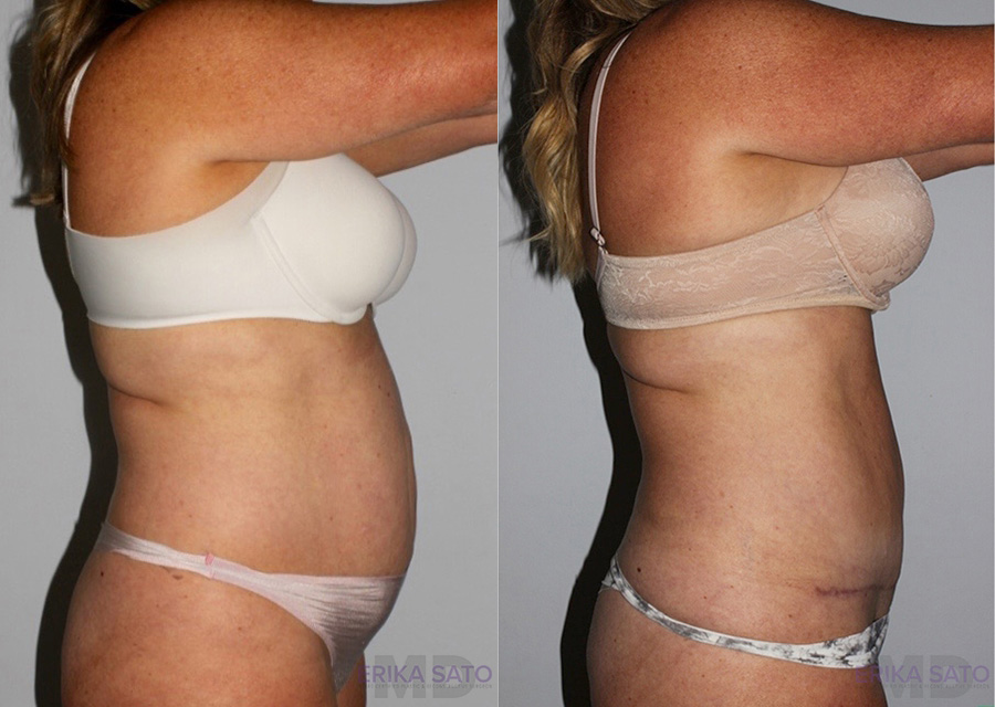 Tummy Tuck case #7091