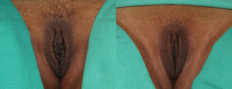 Labiaplasty case #5769