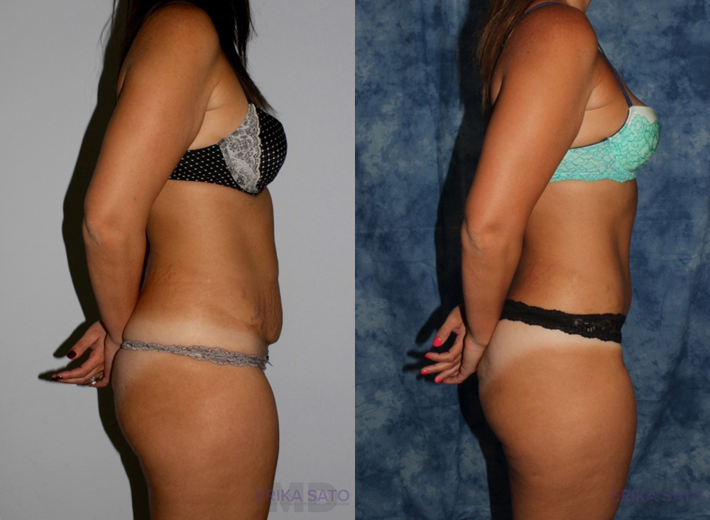 Tummy Tuck case #7225