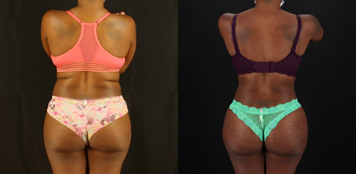 Brazilian Butt Lift case #4822