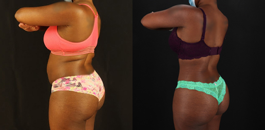 Brazilian Butt Lift case #4822