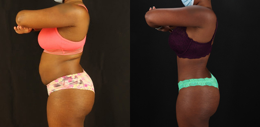 Brazilian Butt Lift case #4822