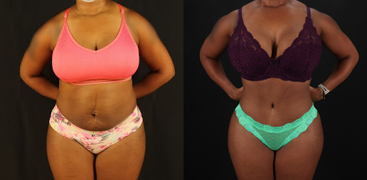 Brazilian Butt Lift case #4822