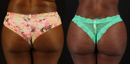 Brazilian Butt Lift case #4822
