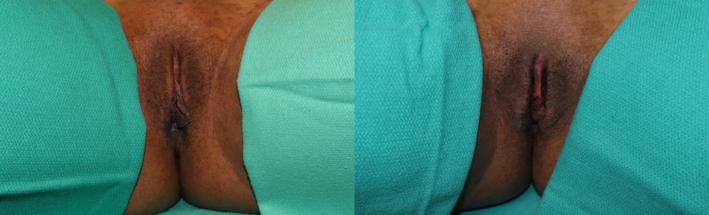 Labiaplasty case #5770