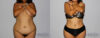 Tummy Tuck case #7095 slider thumbnail