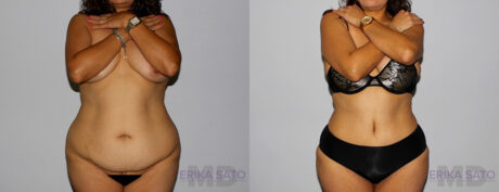 Tummy Tuck case #7095