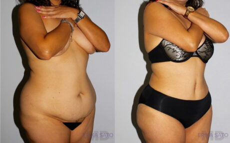 Tummy Tuck case #7095