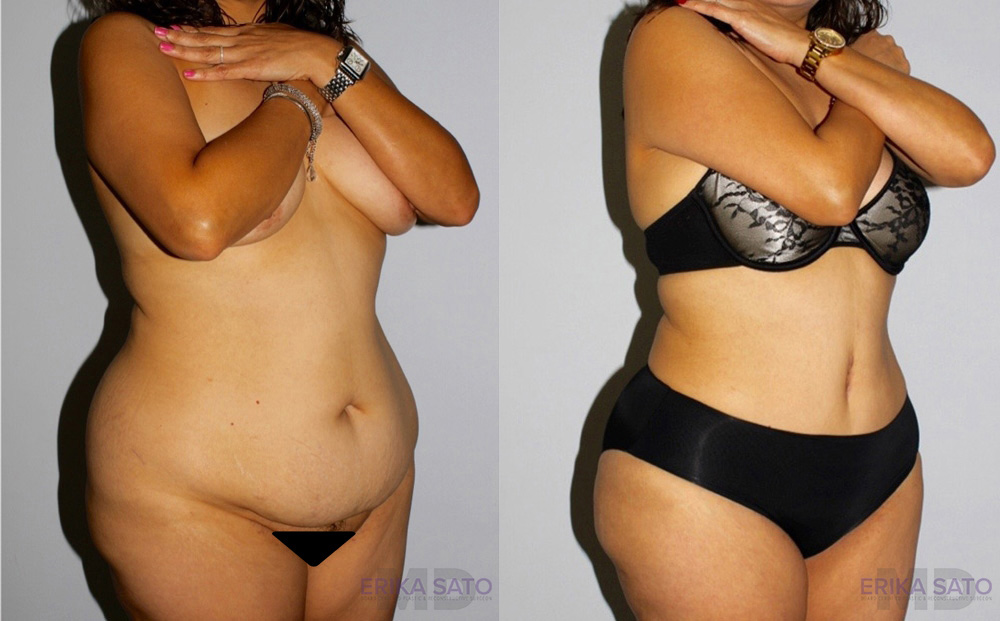Tummy Tuck case #7095